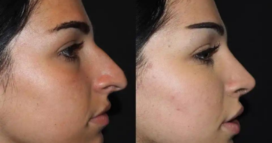 Rhinoplasty Aftercare Tips for a Speedy Recovery