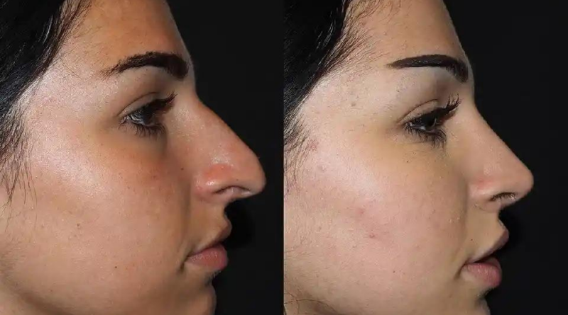 Rhinoplasty Aftercare Tips for a Speedy Recovery