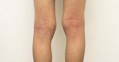 eczema on legs