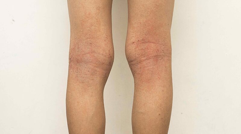 eczema on legs