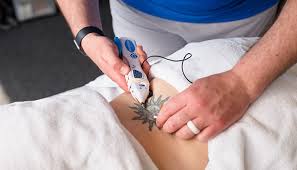 Trigger point dry needling is a highly effective treatment for relieving muscle pain, improving mobility, and enhancing recovery from injuries.