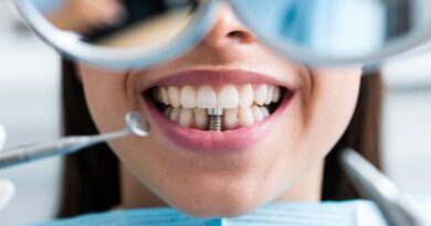 Dental Implants Front Teeth in Orlando FL