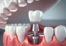 best dental implants in queens