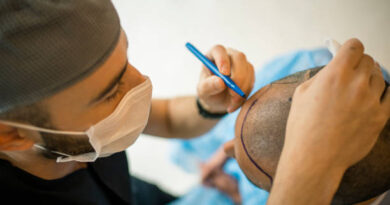 Hair Transplant in Riyadh