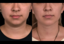 Double chin removal