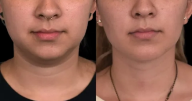 Double chin removal