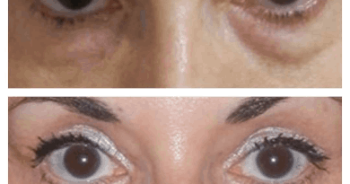 eye bag removal