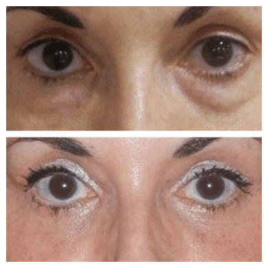 eye bag removal