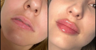 Juvederm