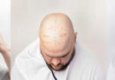 Hair transplant in Karachi