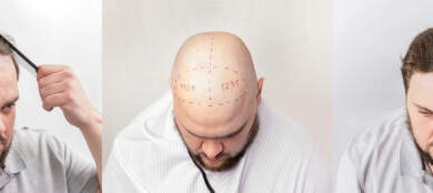 Hair transplant in Karachi