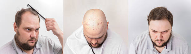 Hair transplant in Karachi