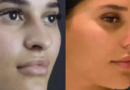 Best Rhinoplasty Surgeon in Dubai: What Sets Them Apart?