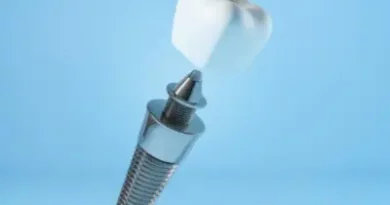 dental Implant Aberdeen