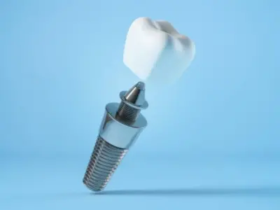 dental Implant Aberdeen