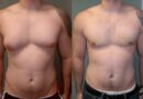 Gynecomastia Surgery in dubai