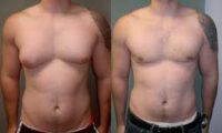 Gynecomastia Surgery in dubai