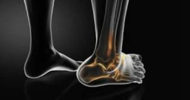 Ankle Fracture Treatment