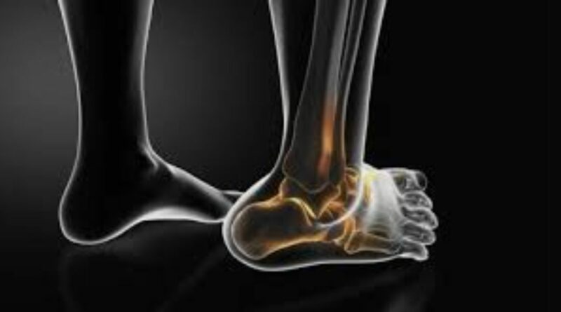 Ankle Fracture Treatment