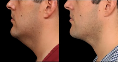 Double Chin Removal