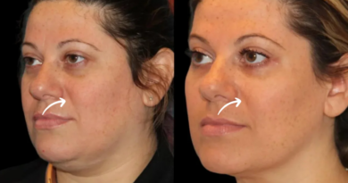 Sculptra Fillers in Dubai for Youthful Skin