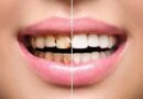 Smile Makeover Dentistry