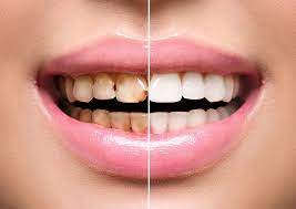 Smile Makeover Dentistry