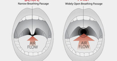 medical treatment for snoring