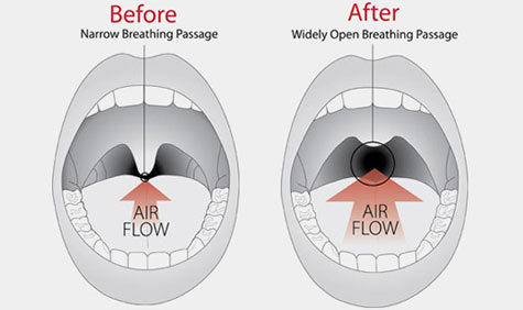 medical treatment for snoring