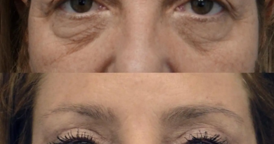 Eye bag removal