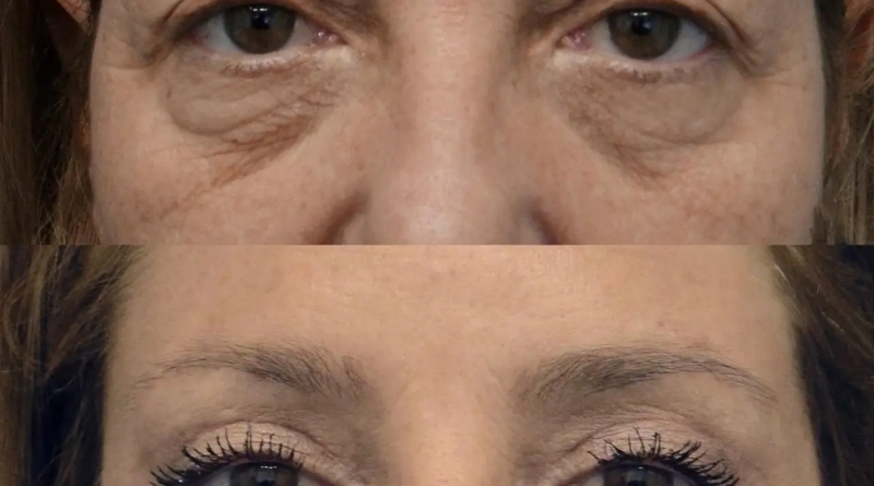 Eye bag removal