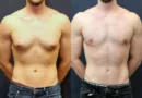 Gynecomastia Surgery in Dubai