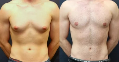 Gynecomastia Surgery in Dubai