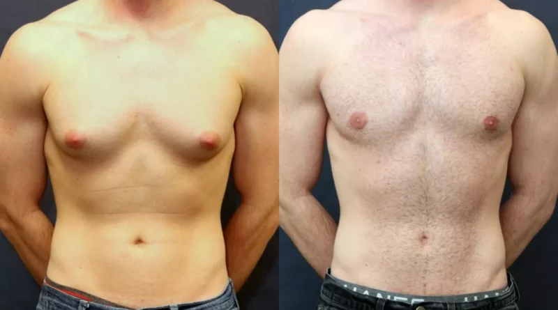 Gynecomastia Surgery in Dubai