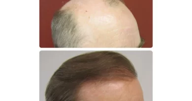 hair restoration michigan