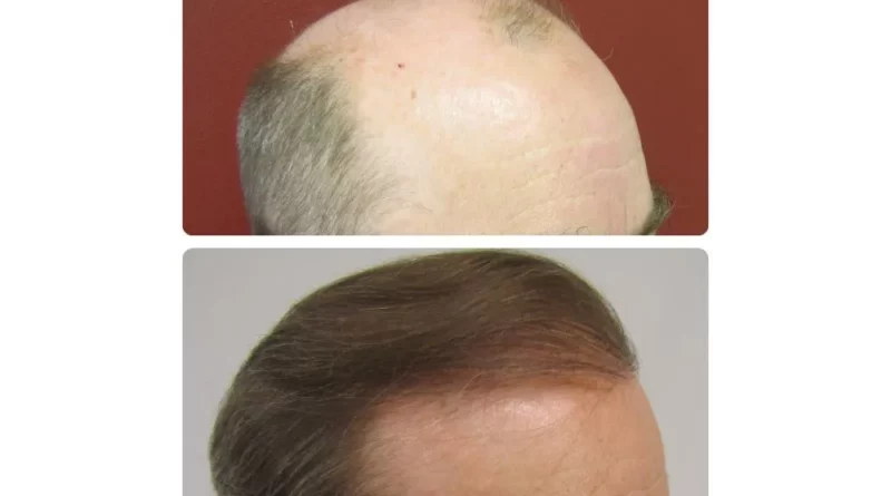 hair restoration michigan