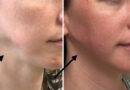 Juvederm Aftercare Made Simple: How To Maintain A Smooth, Radiant Look?