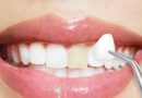 Top 10 Reasons to Get Dental Veneers in the USA