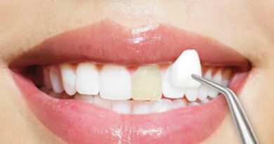 Top 10 Reasons to Get Dental Veneers in the USA