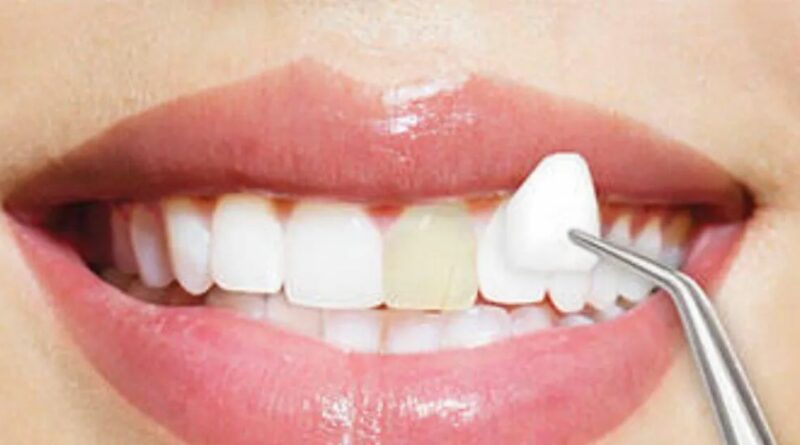 Top 10 Reasons to Get Dental Veneers in the USA