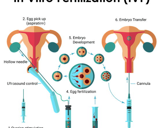 IVF Treatment