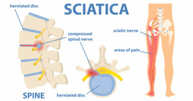 Sciatica pain can be debilitating, causing discomfort and limitations in daily activities for many individuals.