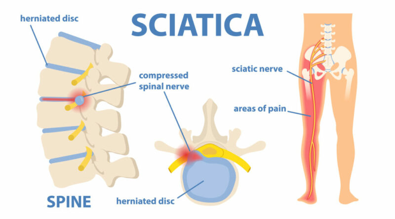 Sciatica pain can be debilitating, causing discomfort and limitations in daily activities for many individuals.