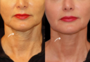 How the Best Plastic Surgeon in dubai Corrects Facial Asymmetry with Sculptra