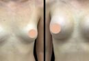 Breast Enhancement Surgery in dubai What to Expect on the Day of Surgery