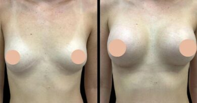 Breast Enhancement Surgery in dubai What to Expect on the Day of Surgery