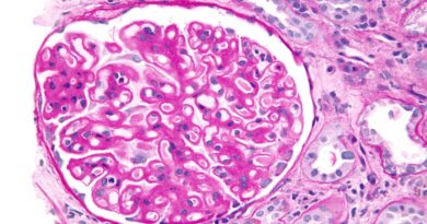 Membranous Nephropathy