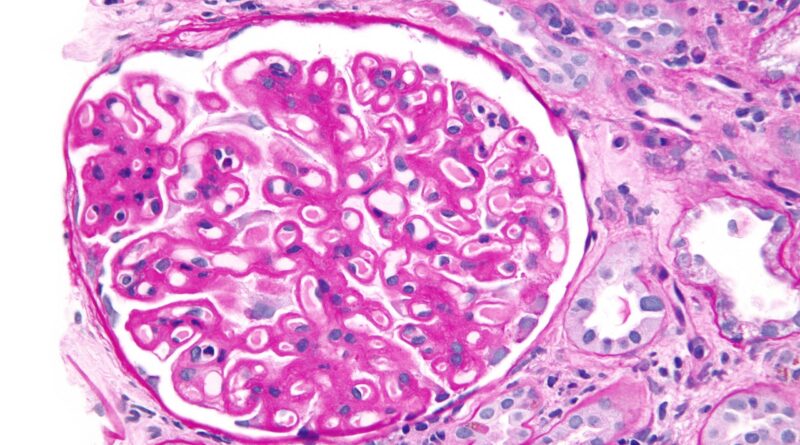 Membranous Nephropathy