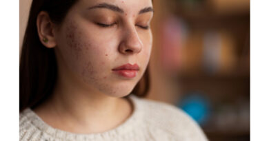 What Are the Long-Term Benefits of Acne Scar Treatment?