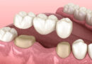 Teeth Bridge Treatment in Lahore